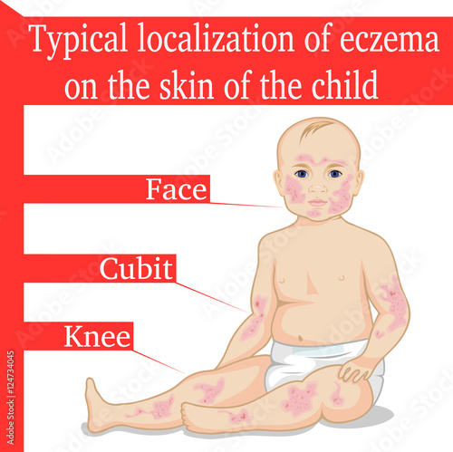 Typical localization of eczema on the skin of child