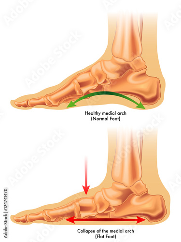 Flat foot