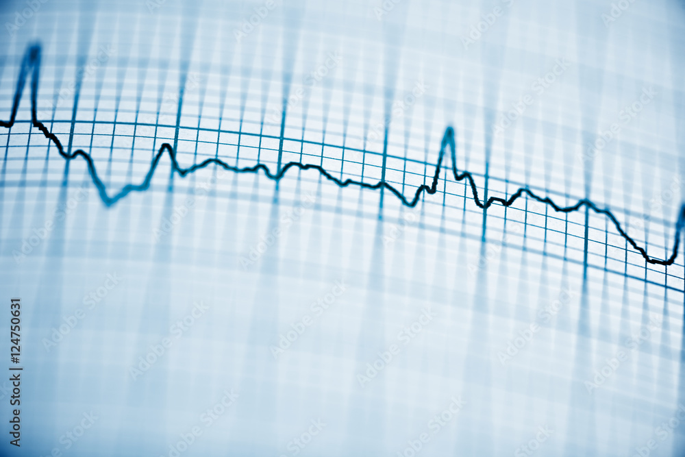 Electrocardiogram Electrocardiogram