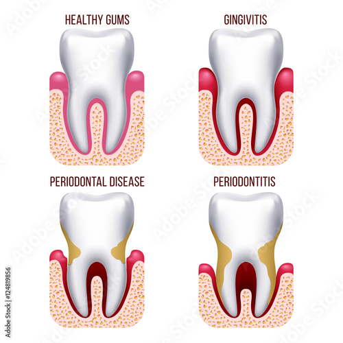 Human gum disease, gums bleeding. Tooth prevention dental, oral care vector infographics