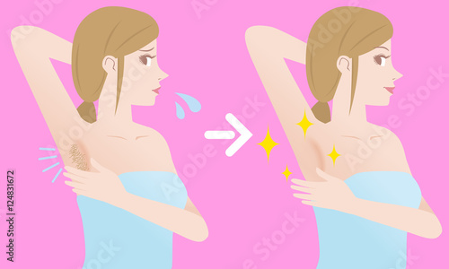 women's underarm hair removal before after concept, unwanted hair, superfluous hair, vector illustration