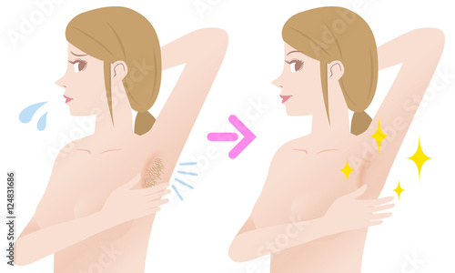 women's underarm hair removal before after concept, unwanted hair, superfluous hair, vector illustration