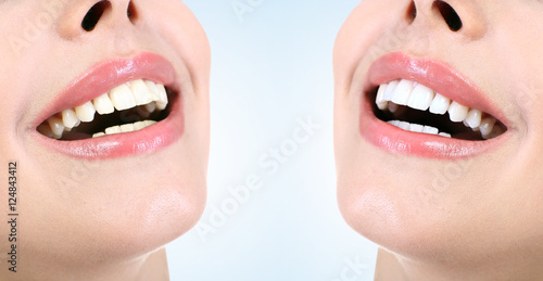 Demonstration of dental whi...