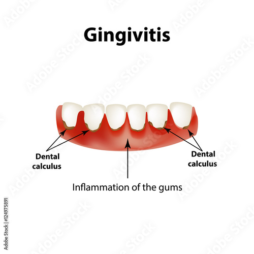 Gingivitis. Inflammation of the gums. Dental calculus. Infographics. Vector illustration on isolated background
