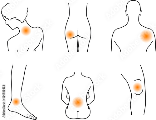 Schmerzpunkte bei Arthrose