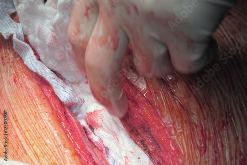 Control of traumatic bleeding during surgery photo