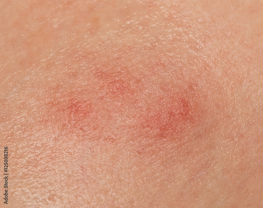 redness of the skin from a mosquito bite redness of the skin from a mosquito bite