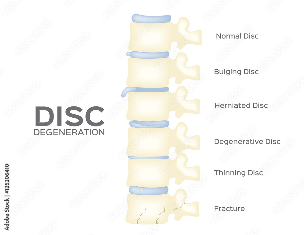 spine disc degeneration vector . back bone . anatomy Stock Vector ...