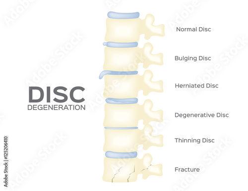 spine disc degeneration vector . back bone . anatomy