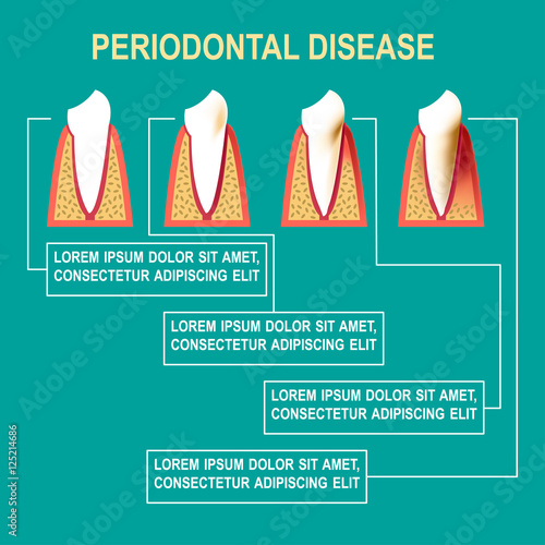 Periodontal disease Vector illustration Medical poster about the stages of development of periodontal disease