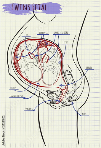 diagram amniotik sack twins