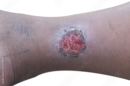 Leg ulcers
