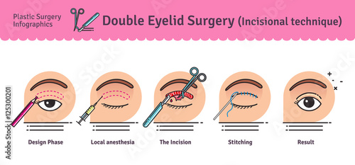 Vector Illustrated set with double eyelid surgery