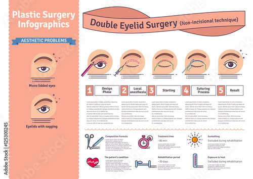 Vector Illustrated set with double eyelid surgery. Non-incisional technique