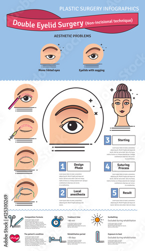 Vector Illustrated set with double eyelid surgery. Non-incisional technique