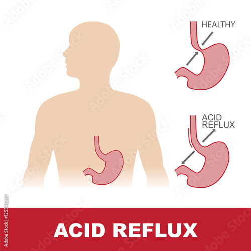 vector illustration of comparison of healty stomach and with acid reflux