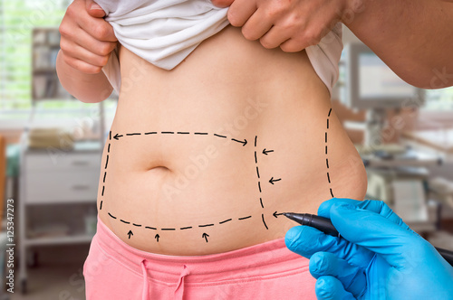 Εκτύπωση καμβά Plastic surgery doctor draw lines with marker on patient belly