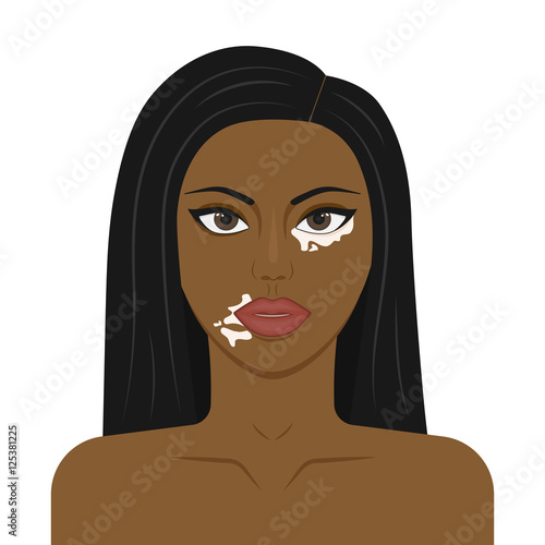 Vector illustration of a young girl with symptoms of vitiligo on the face. Skin pigmentation.