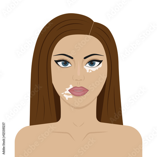 Vector illustration of a young girl with symptoms of vitiligo on the face. Skin pigmentation.