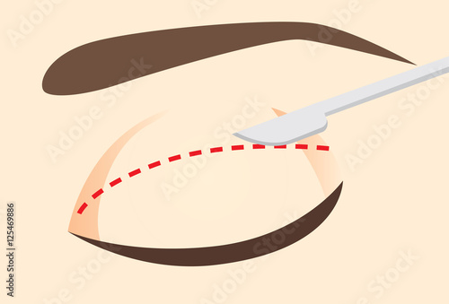 Knife on the eyelid along the designed incision line. Illustration about double eyelid surgery. 