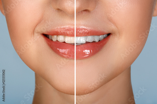 Female teeth whitening before and after the procedure, big lips mouth open, straight beautiful teeth. brush your teeth. Beautiful Smile for woman's face. White smooth natural teeth. Blue background
