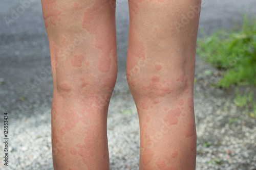 skin allergies, legs skin women. photo