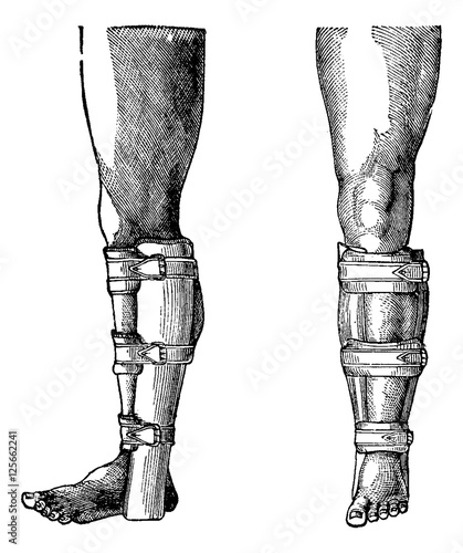 Splint Applied to a Fractured Leg, vintage engraving