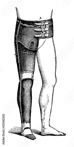 Artificial Leg for Full Hip Disarticulation, vintage engraving
