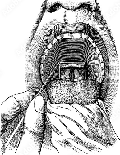 Laryngoscopy, vintage engraving