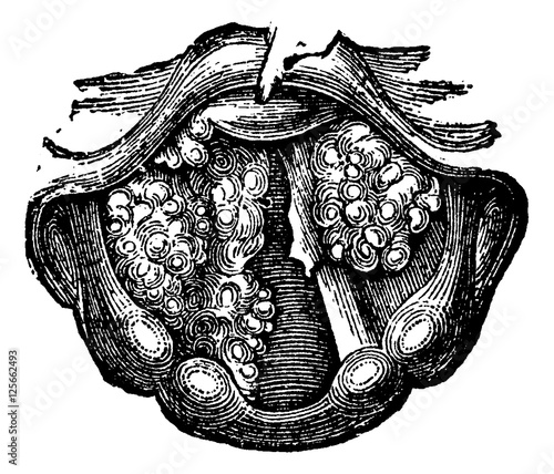 Multiple Papilloma of the Larynx, vintage engraving