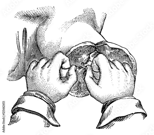 Ligation of the artery after amputation of the thigh. Way to hav