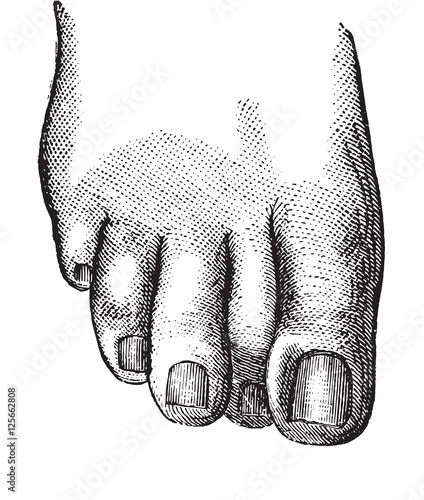 Faulty position of the second toe causing the embodiment of the