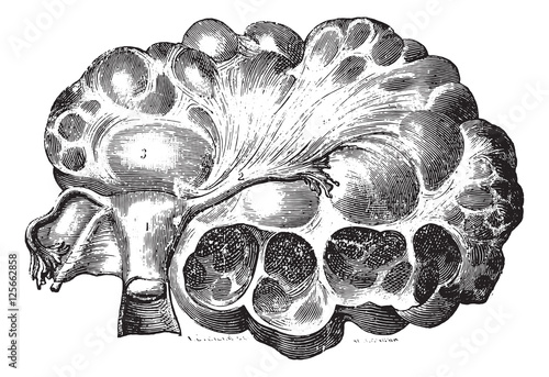 Multilocular cyst of the left ovary, vintage engraving.
