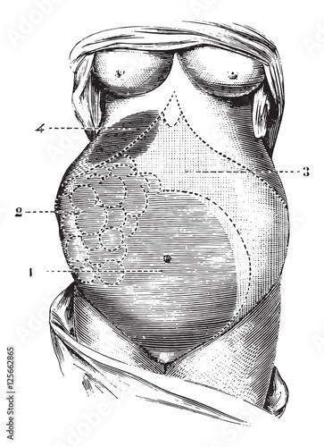 Multilocular ovarian cyst, vintage engraving.