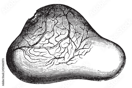 Ovary of the bladder presenting a very supported and will count