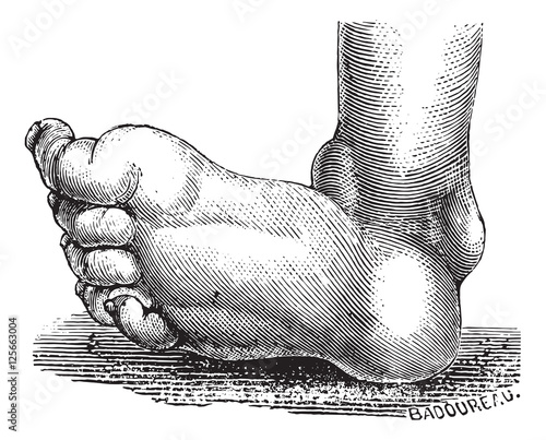 Clubfoot or congenital talipes equinovarus, vintage engraving.