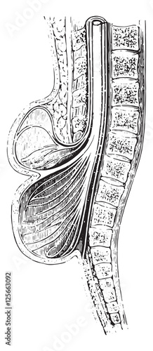 Cup anteroposterior spinal practiced on a spina bifida, vintage