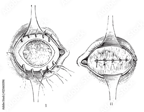 Removal of the anterior segment of the eye with total staphyloma