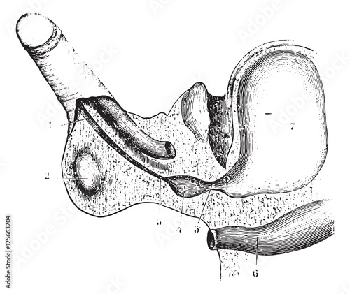 Urinary incontinence, vintage engraving.
