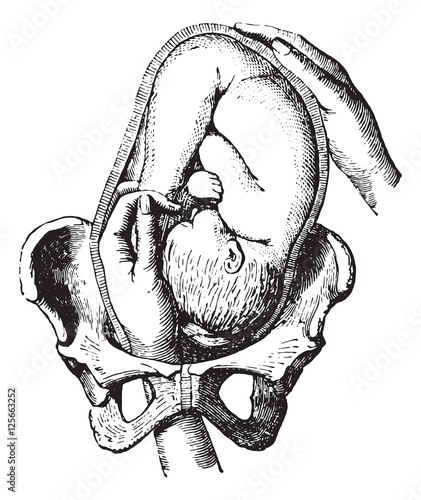 External cephalic version, vintage engraving.