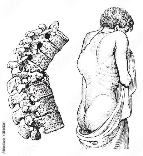 Hump of the vertebral disease or Pott's disease, vintage engravi