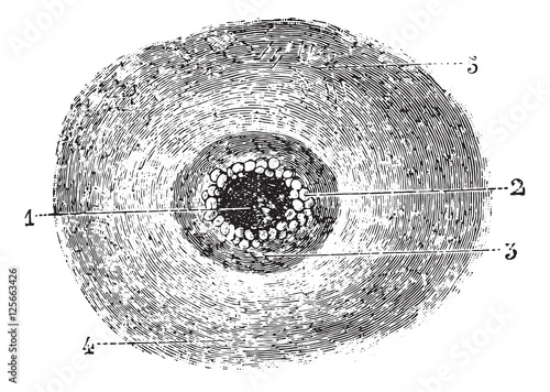 Malignant pustule or Anthrax, vintage engraving.