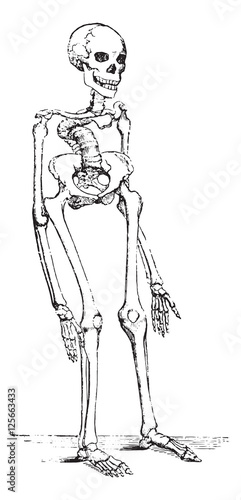 Skeleton deformed by rickets which deflected the spinal column, vintage engraving.