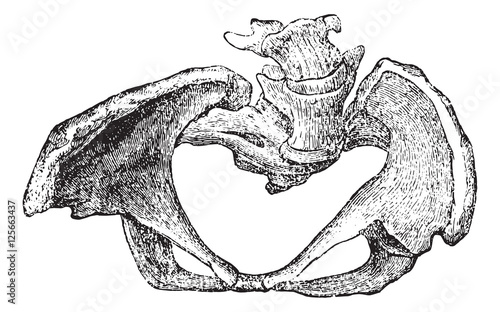 Basin deformed by rickets, vintage engraving.
