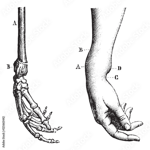 Canvas Print Fracture of the lower extremity of the radius, vintage engraving