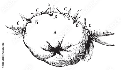 Extirpation of the lower end of the rectum by the method of liga