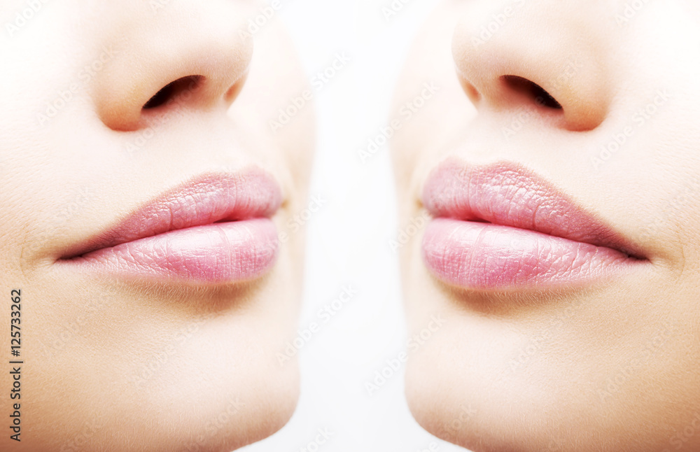 Obraz premium Before and after lip filler injections. Close up over white background