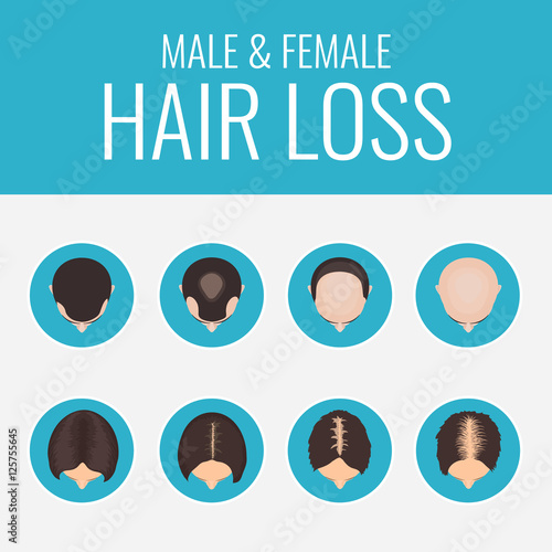 Male and female pattern hair loss set. Stages of baldness in men and women. Alopecia infographic medical design template. Hair loss clinic concept design. Vector illustration.