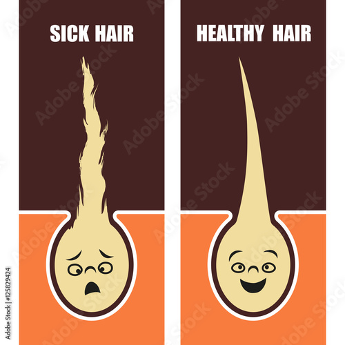 Medical Educational poster, sick and healthy hair. Vector illustration.