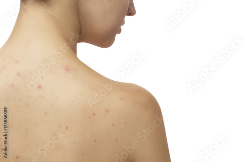 Young girl with skin problem (acne) on the back
